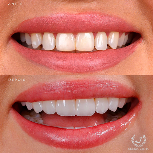Clareamento dental com abordagem funcional