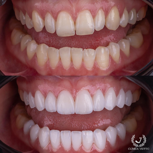 Clareamento dental com segurança clínica