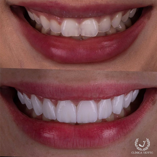 Facetas de Porcelana Viotto de luxo