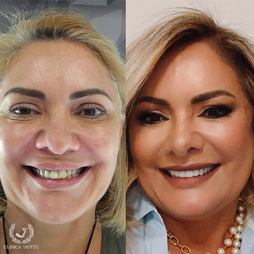 Harmonização facial odontológica