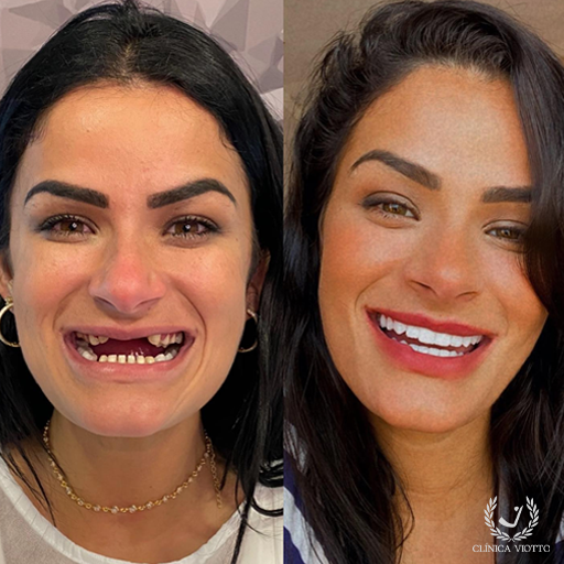 Tratamento com implante dentário de carga imediata