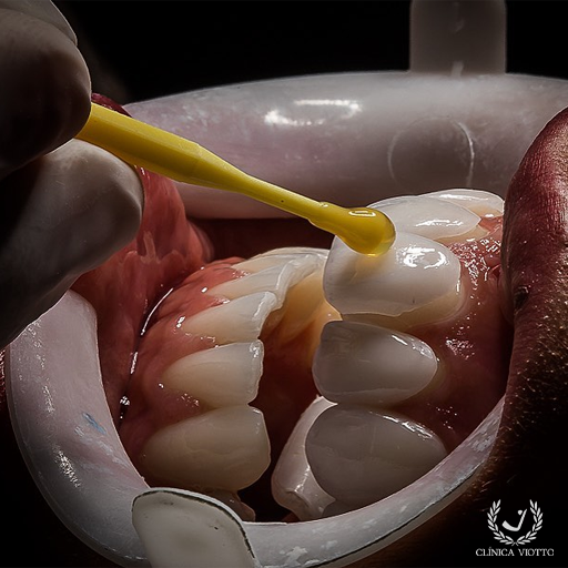 Tratamento com lente dental de porcelana
