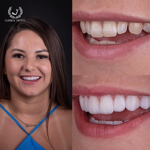 Tratamento de clareamento dental