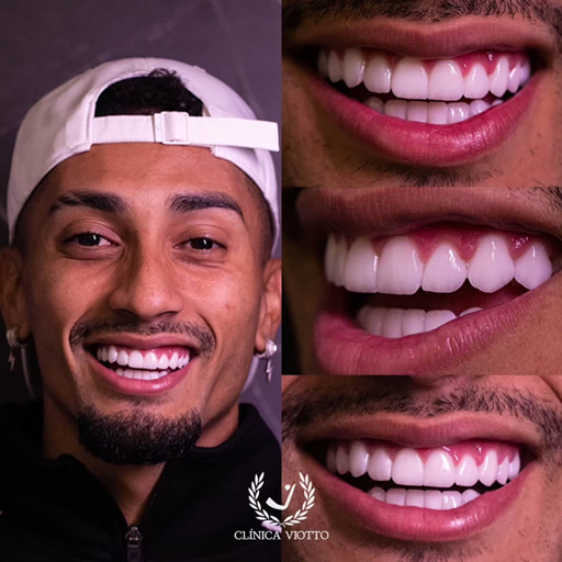 Tratamento indicado para sorriso harmônico