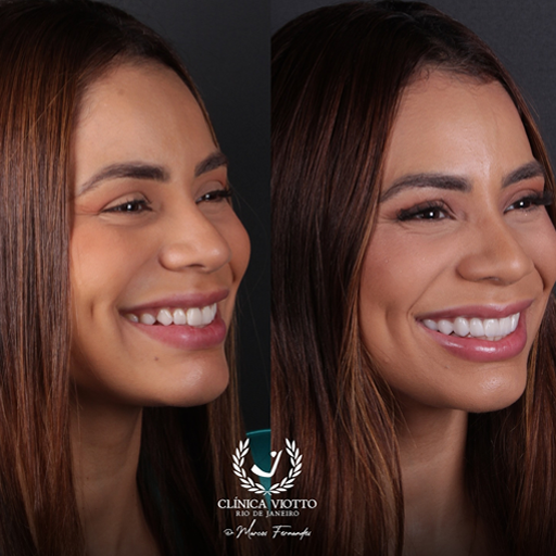 Tratamento indicado para sorriso harmônico